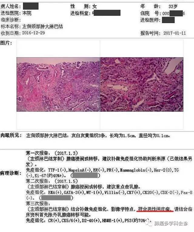 恶性胸膜间皮瘤的影像有特征,病理有点难