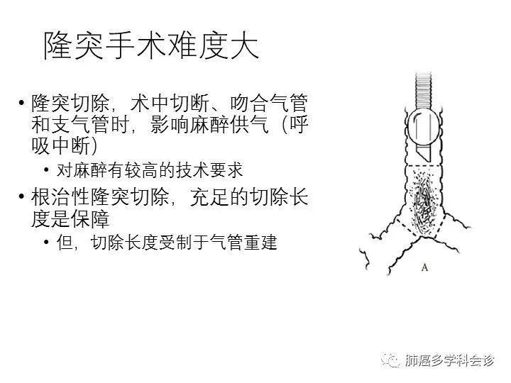 隆突切除重建术治疗局部晚期nsclc—抗癌管家