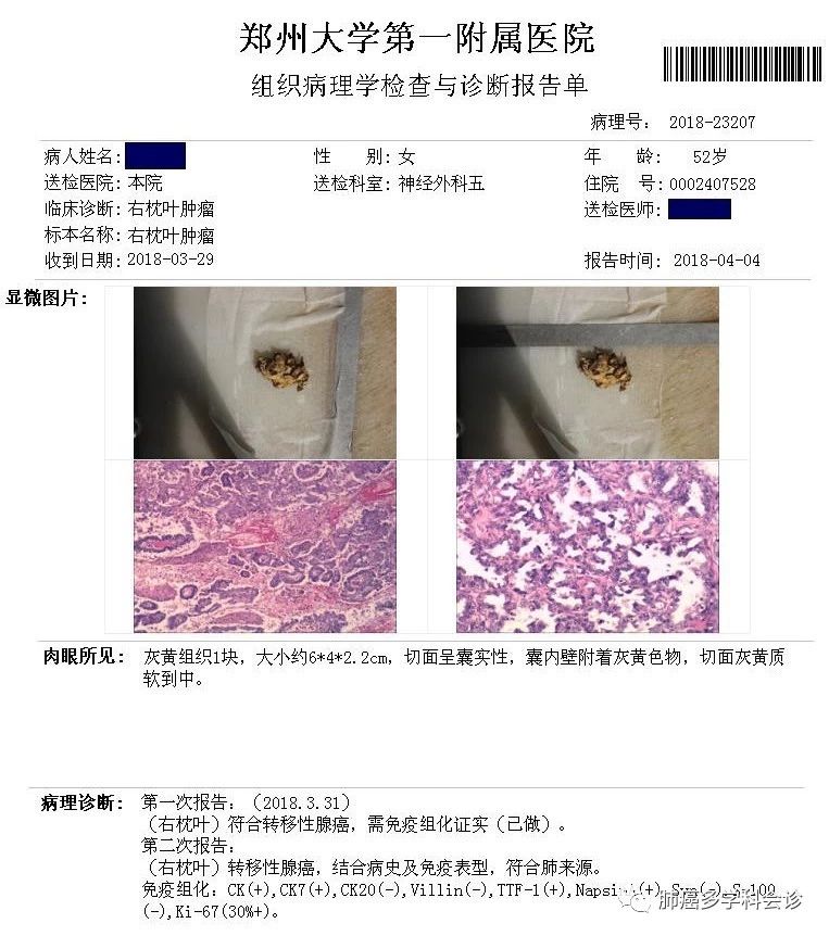 张咪自曝第三次患癌将切掉半个舌头 这些人群需求前期、定时监测