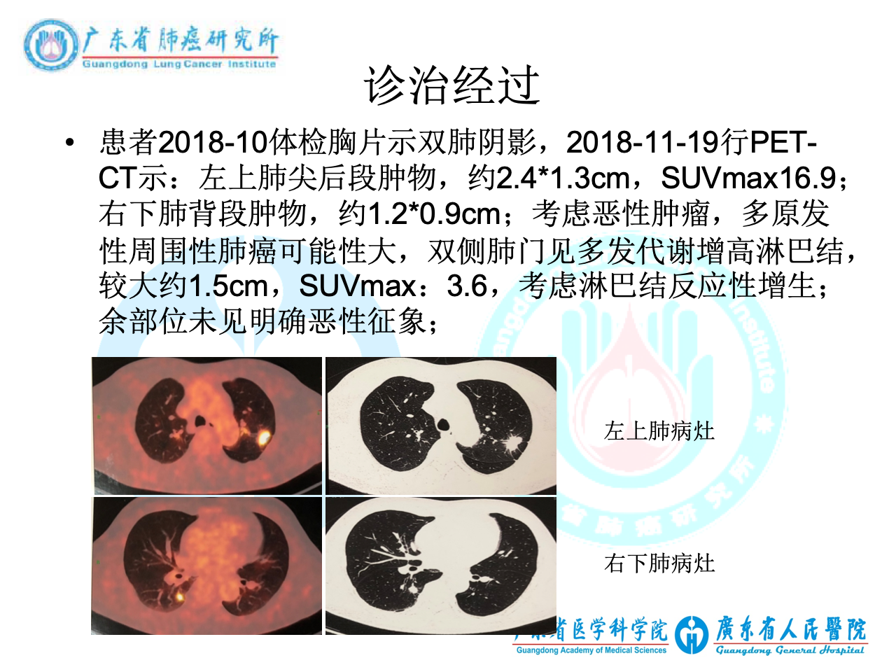 右下肺腺癌Ⅲa期 左上肺腺癌Ⅰa3期,双病灶egfr l858r