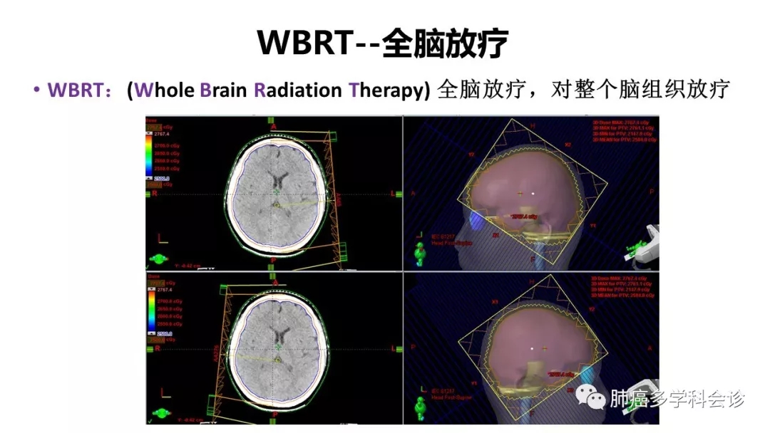 一次性完成治疗剂量,像外科手术样去除肿瘤,所以称为放疗"刀", sf-srs